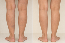 Demonstrative before and after leg comfort visual